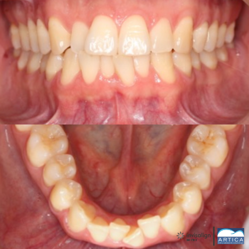5496 Antes y despues ortodoncia invisible Antes