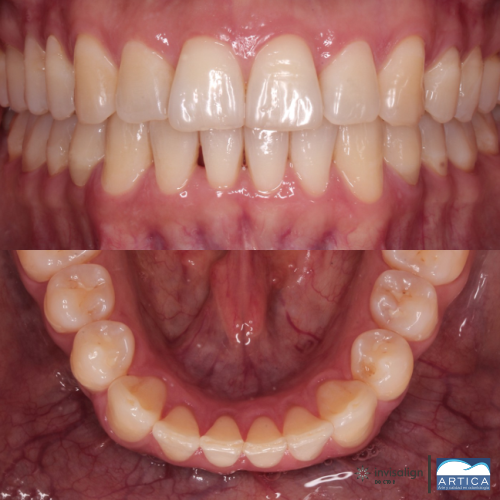 5496 Antes y despues ortodoncia invisible Despues