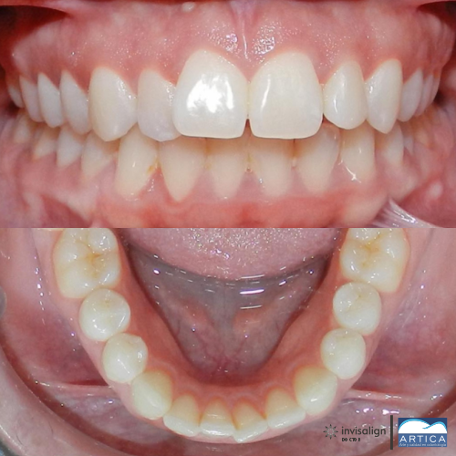 9569 Antes y despues ortodoncia invisible Antes